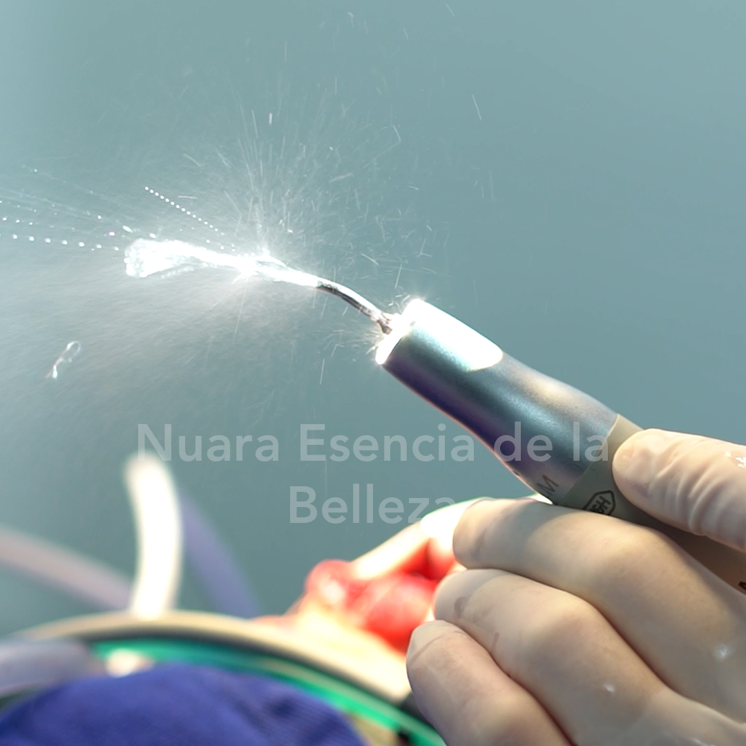 Rinoplastia Ultrasonica By Dr. Minyor Avellaneda