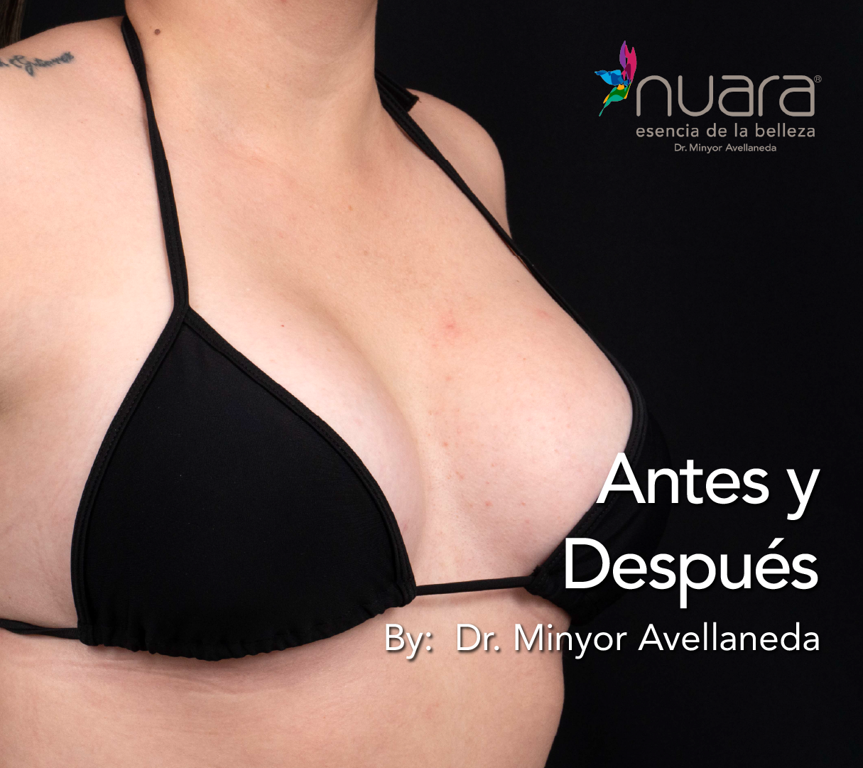 Mamoplastia de Aumento By Dr Minyor Avellaneda