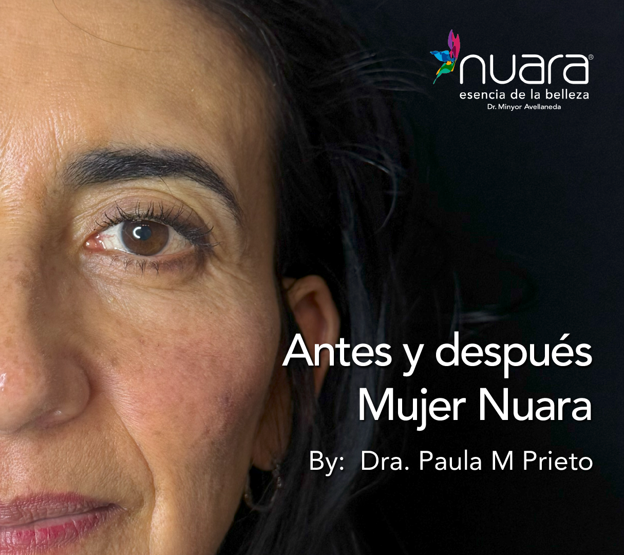 Protocolo Acne por Dra Paula M Prieto
