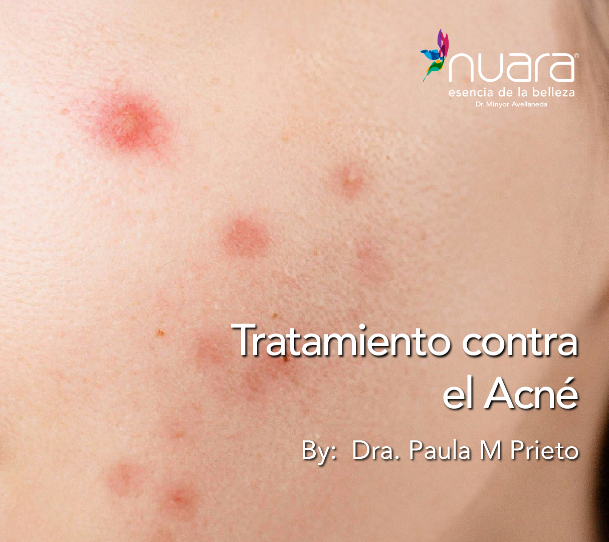 Protocolo Acne por Dra Paula M Prieto