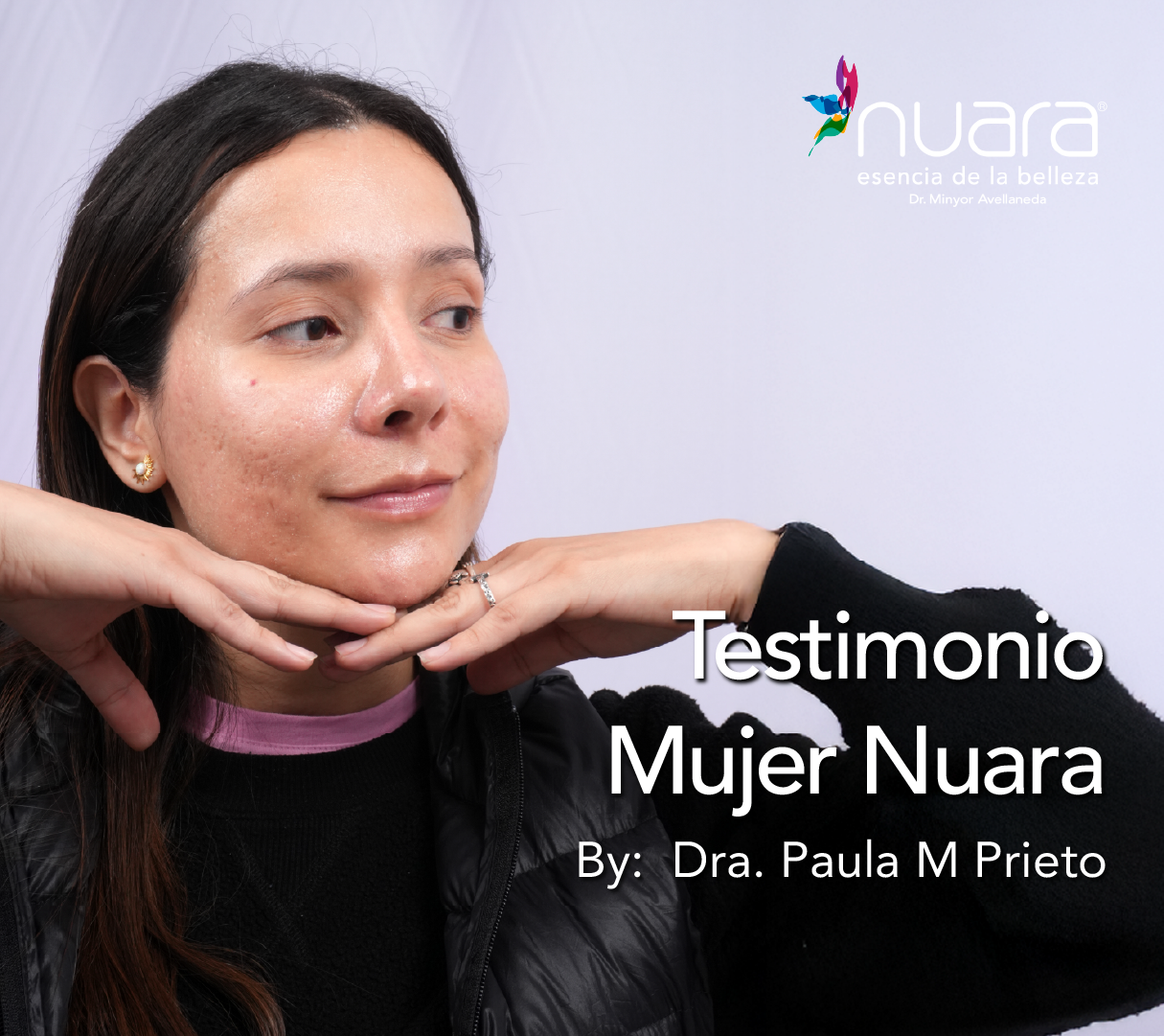 Protocolo Acne por Dra Paula M Prieto