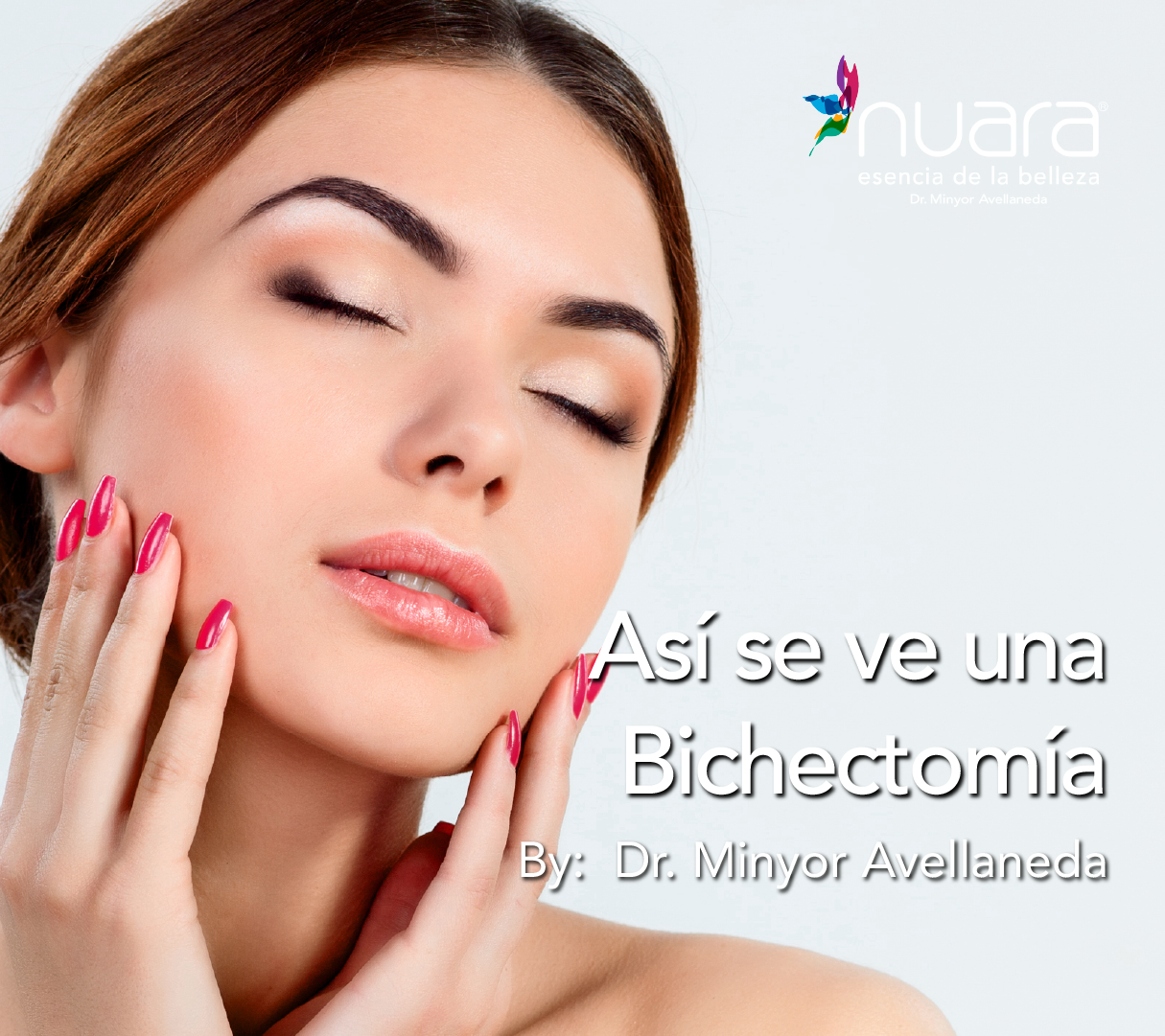 Bichectomía by Dr Minyor Avellaneda.