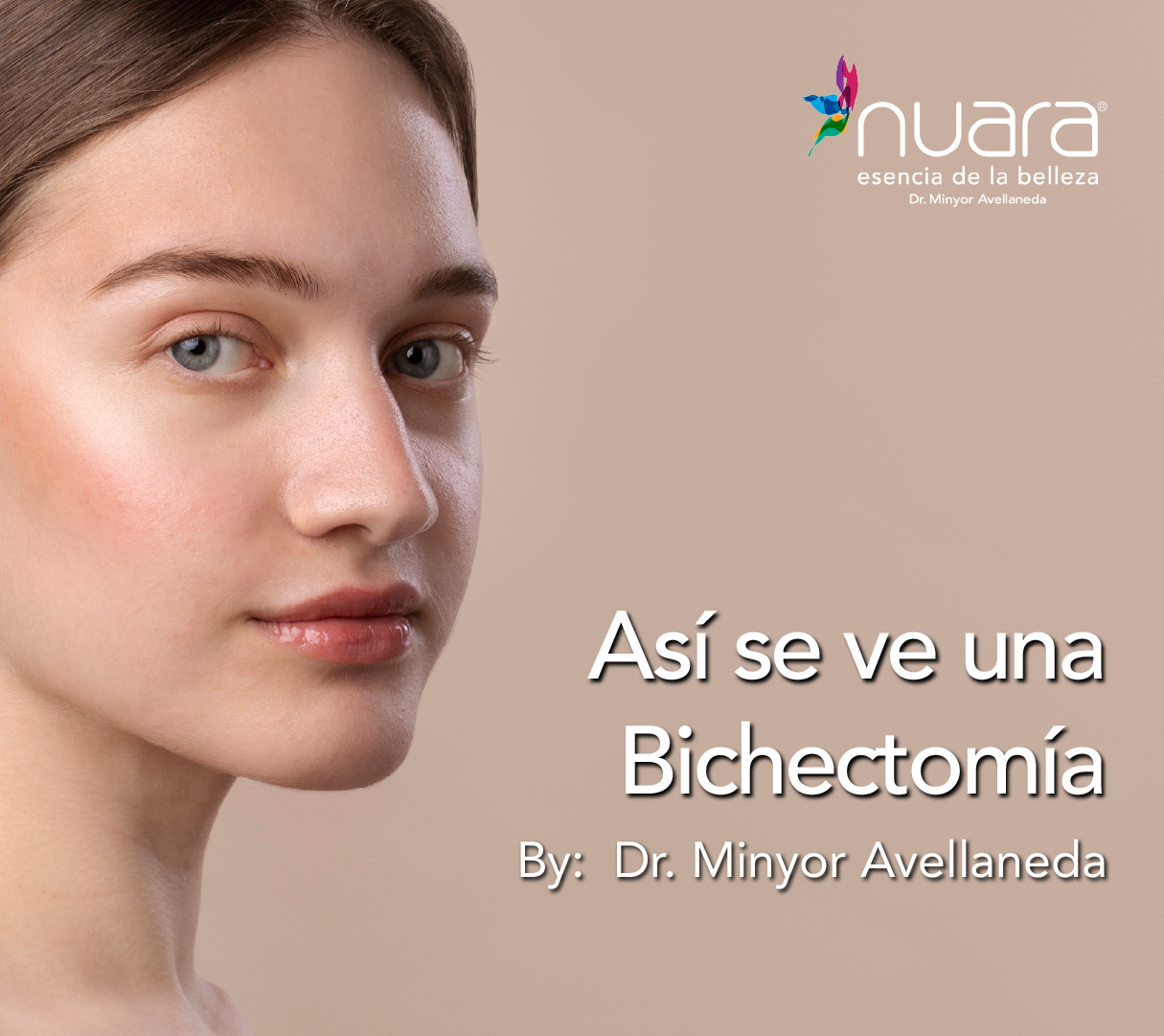 Bichectomía by Dr Minyor Avellaneda.