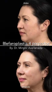 Blefaroplastia - Dr. Minyor Avellaneda Blefaroplastia en Bogotá. Resultado 4 parpados con cicatrices imperceptibles.