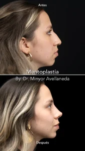 antes-despues-mentoplastia-dr-minyor-avellaneda antes despues mentoplastia dr minyor avellaneda Nuara Belleza