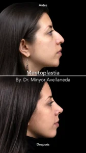 antes-despues-mentoplastia-lateral-dr-minyor-avellaneda antes despues mentoplastia lateral dr minyor avellaneda Nuara Belleza