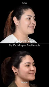 Bichectomía en Bogotá | Perfilamiento Facial | Dr. Minyor Bichectomía en Bogotá antes y después - Dr Minyor Avellaneda. Vista diagonal.