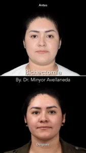 Bichectomía en Bogotá | Perfilamiento Facial | Dr. Minyor Bichectomía en Bogotá antes y después - Dr Minyor Avellaneda. Vista frontal.