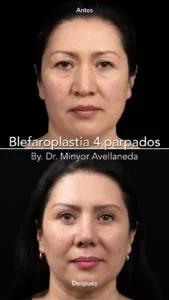 Blefaroplastia - Dr. Minyor Avellaneda Blefaroplastia en Bogotá. Antes y después de cirugía en paciente con dermatochalasis y bolsas grasas.