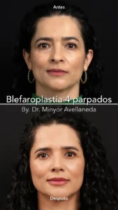 Blefaroplastia - Dr. Minyor Avellaneda Antes y después de Blefaroplastia en Bogotá de 4 parpados mostrando eliminación de piel sobrante y bolsas.