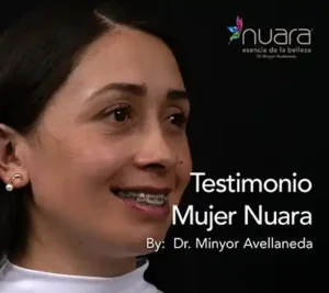 Blefaroplastia - Dr. Minyor Avellaneda Resultado de blefaroplastia inferior en paciente joven para eliminar bolsas en los ojos en Bogotá.