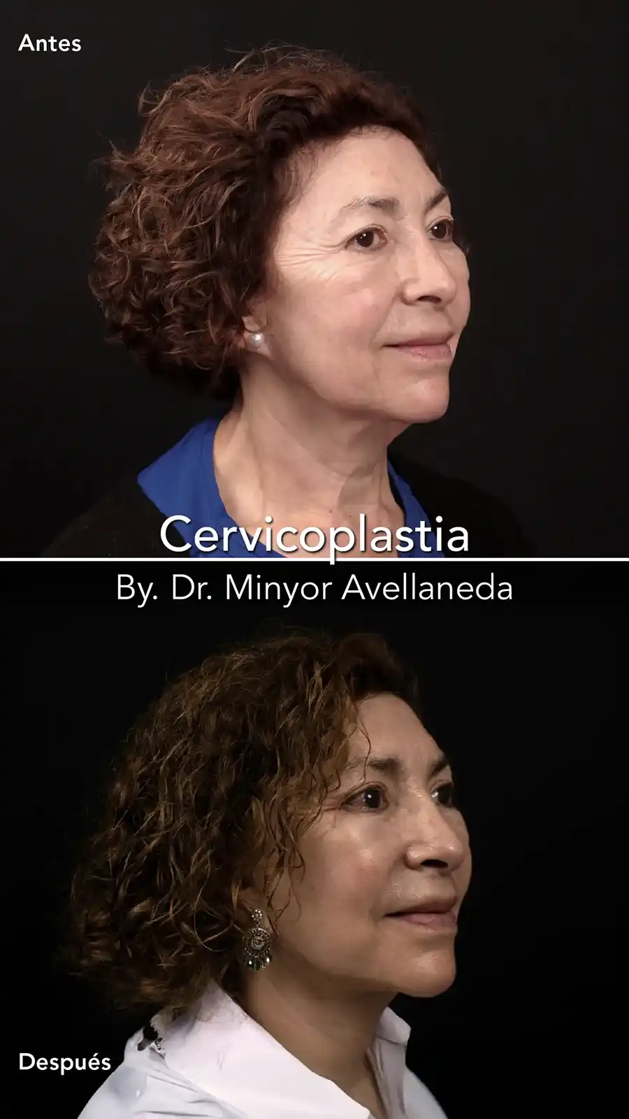 Cervicoplastia - Dr. Minyor Avellaneda Cervicoplastia en Bogotá. Antes y después de una cirugía realizada por el Dr. Minyor Avellaneda mostrando definición del cuello.
