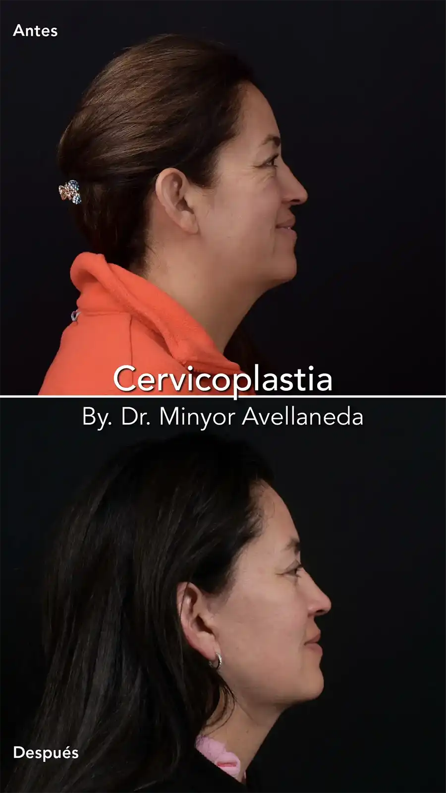 Cervicoplastia - Dr. Minyor Avellaneda Cervicoplastia en Bogotá, para eliminación de papada y flacidez cervical con el Dr. Minyor Avellaneda.
