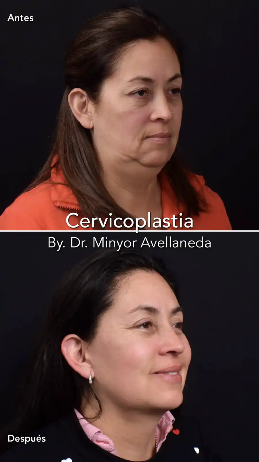 Cervicoplastia - Dr. Minyor Avellaneda Cervicoplastia en Bogotá por el Dr. Minyor Avellaneda mostrando eliminación de papada y flacidez en el cuello.