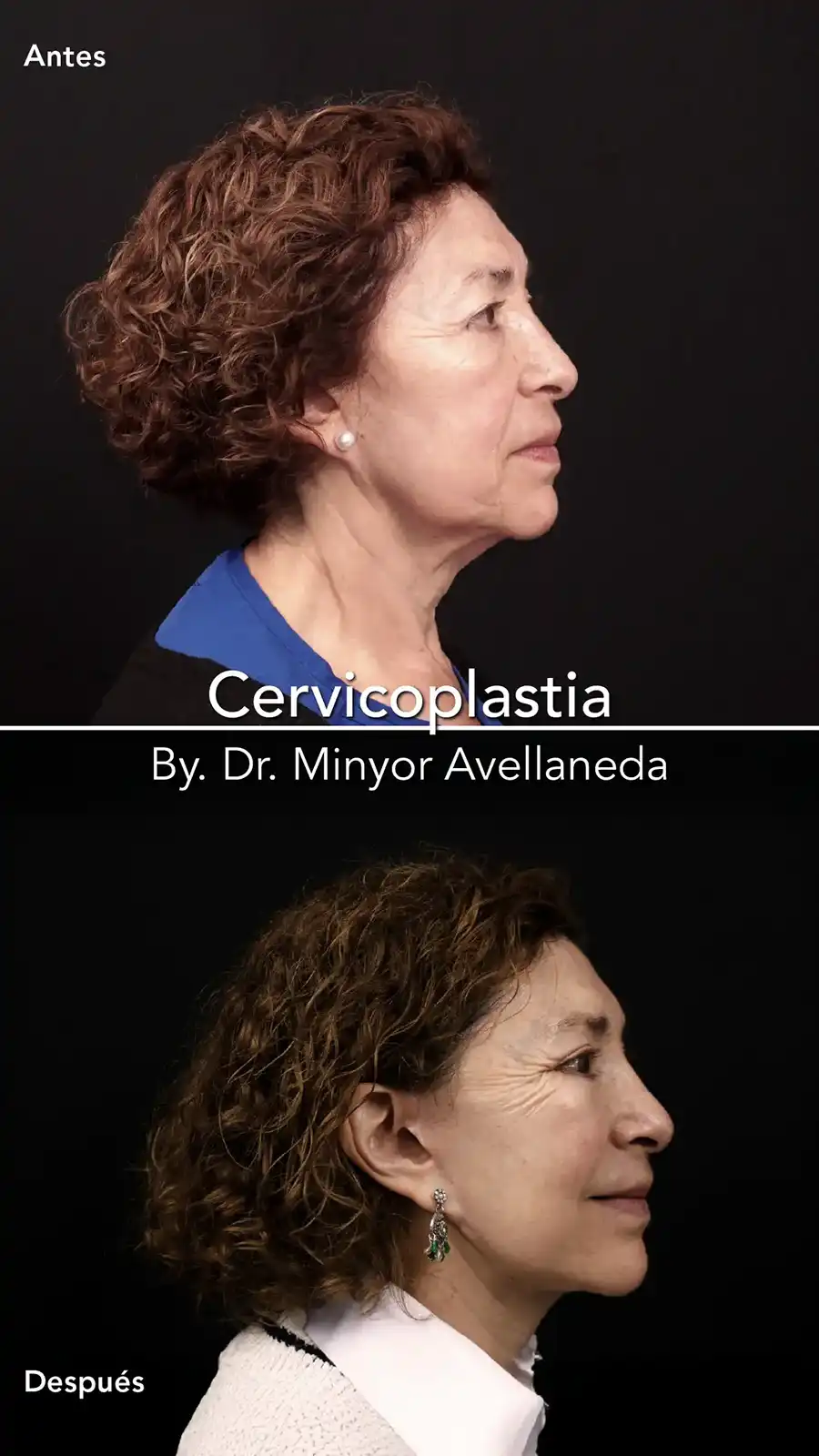 Cervicoplastia - Dr. Minyor Avellaneda Cervicoplastia en Bogotá con el Dr. Minyor Avellaneda, resaltando el ángulo mandibular.
