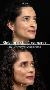 Blefaroplastia - Dr. Minyor Avellaneda Paciente en vista lateral tras Blefaroplastia en Bogotá de 4 parpados con resultados naturales.
