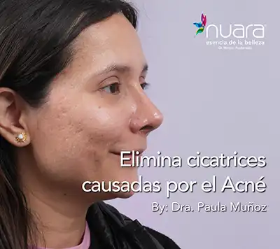 eliminar cicatrices acne laser co2 Nuara Belleza