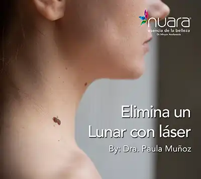 eliminar lunar acne laser co2 Nuara Belleza