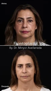 Frontoplastia Vista Frontal - Dr. Minyor Avellaneda Frontoplastia en Bogotá. Con el Dr. Minyor Avellaneda mostrando antes y después de elevación de cejas y mirada despejada.
