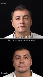 Frontoplastia Masculina Frontal - Dr. Minyor Avellaneda Frontoplastia en Bogotá. Antes y después masculino con el Dr. Minyor Avellaneda, mostrando reducción de arrugas frontales.