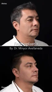 Frontoplastia Masculina Perfil - Dr. Minyor Avellaneda Frontoplastia en Bogotá. Perfil de paciente masculino antes y después realizado por el Dr. Minyor Avellaneda.