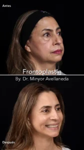 Frontoplastia Perfil Oblicuo - Dr. Minyor Avellaneda Frontoplastia en Bogotá. Con el Dr. Minyor Avellaneda mostrando antes y después de perfil oblicuo.