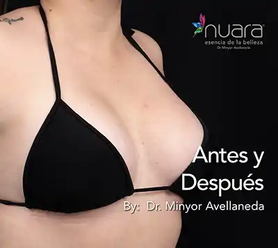 Mamoplastia de Aumento - Dr. Minyor Avellaneda Mamoplastia de Aumento en Bogotá. Antes y Después por el Dr. Minyor AVellaneda.