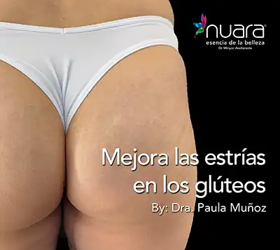Nanopore l Nuara Esencia de la Belleza mejora las estrias en gluteos nanopore nuara belleza Nuara Belleza