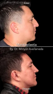 mentoplastia-antes-despues-dr-minyor-avellaneda mentoplastia antes despues dr minyor avellaneda Nuara Belleza