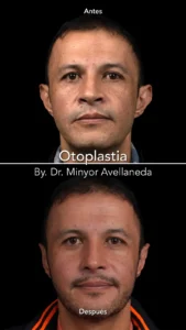 Otoplastia Antes y Después - Dr. Minyor Avellaneda Resultados de Otoplastia en Bogotá por el Dr. Minyor Avellaneda: comparativa antes y después de corrección de orejas.