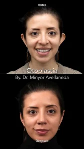 Otoplastia Antes y Después - Dr. Minyor Avellaneda Resultados de Otoplastia en Bogotá por el Dr. Minyor Avellaneda: comparativa antes y después de corrección de orejas.