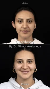 Otoplastia Antes y Después - Dr. Minyor Avellaneda Resultados de Otoplastia en Bogotá por el Dr. Minyor Avellaneda: comparativa antes y después de corrección de orejas.
