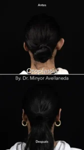 Otoplastia Resultados Reales - Dr. Minyor Avellaneda Antes y después de otoplastia con el Dr. Minyor Avellaneda, mostrando la corrección estética de orejas prominentes.