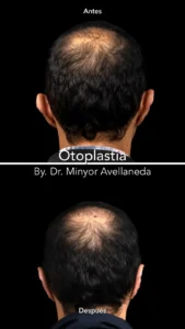 Otoplastia Resultados Reales - Dr. Minyor Avellaneda Antes y después de otoplastia con el Dr. Minyor Avellaneda, mostrando la corrección estética de orejas prominentes.