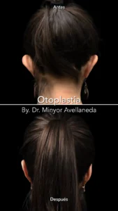 Otoplastia Resultados Reales - Dr. Minyor Avellaneda Antes y después de otoplastia con el Dr. Minyor Avellaneda, mostrando la corrección estética de orejas prominentes.