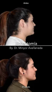 Bichectomía en Bogotá | Perfilamiento Facial | Dr. Minyor Bichectomía en Bogotá antes y después - Dr Minyor Avellaneda. Vista lateral.