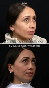 Blefaroplastia - Dr. Minyor Avellaneda Vista lateral de resultados de Blefaroplastia en Bogotá; reducción de grasa infraorbitaria y piel sobrante.