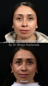 Blefaroplastia - Dr. Minyor Avellaneda Antes y después de Blefaroplastia en Bogotá mostrando eliminación de bolsas y ojeras en paciente femenina.
