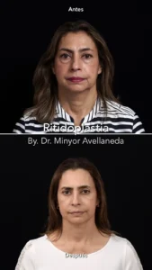 Ritidoplastia - Dr. Minyor Avellaneda Comparativa de antes y después frontal de Ritidoplastia en Bogotá mostrando rejuvenecimiento facial natural.