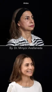 Ritidoplastia - Dr. Minyor Avellaneda Mujer sonriendo satisfecha tras su procedimiento de ritidoplastia en Bogotá en la clínica del Dr. Avellaneda.