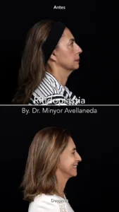 Ritidoplastia - Dr. Minyor Avellaneda Resultado lateral de ritidoplastia en Bogotá destacando la definición de la mandíbula y eliminación de papada.