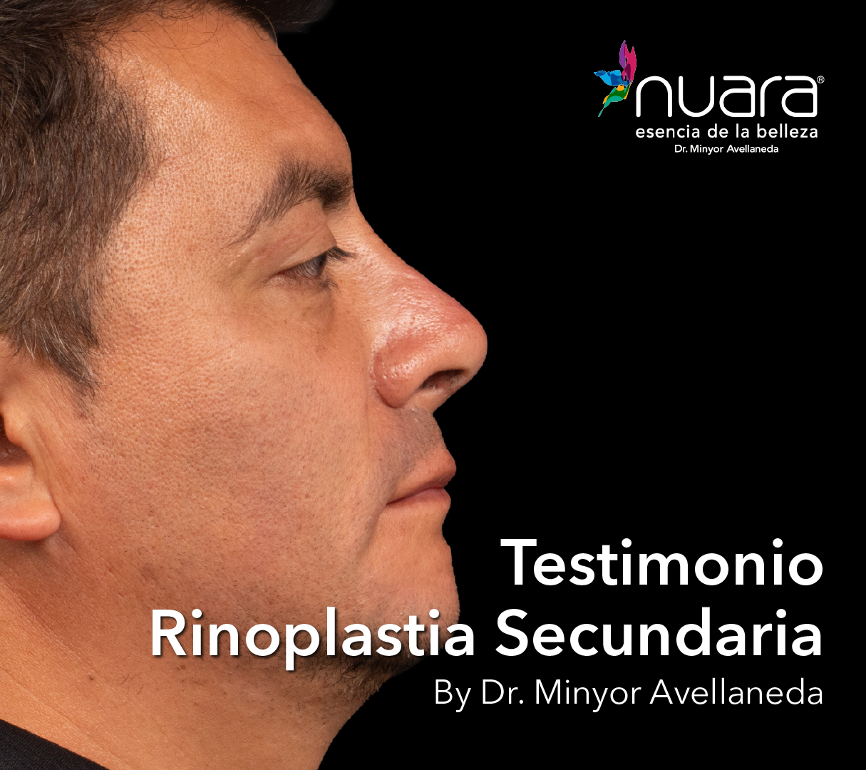 testimonio-rinoplastia-secundaria-dr-minyor-avellaneda testimonio rinoplastia secundaria dr minyor avellaneda Nuara Belleza