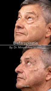Blefaroplastia Perfil Antes y Después Blefaroplastia antes y despues en perfil de hombre con bolsas en parpados, mirada rejuvenecida