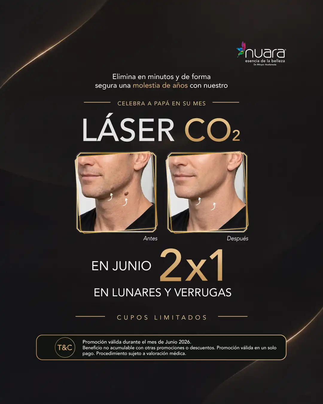 Promoción Láser 2x1 en Nuara Bogotá - Junio 2026