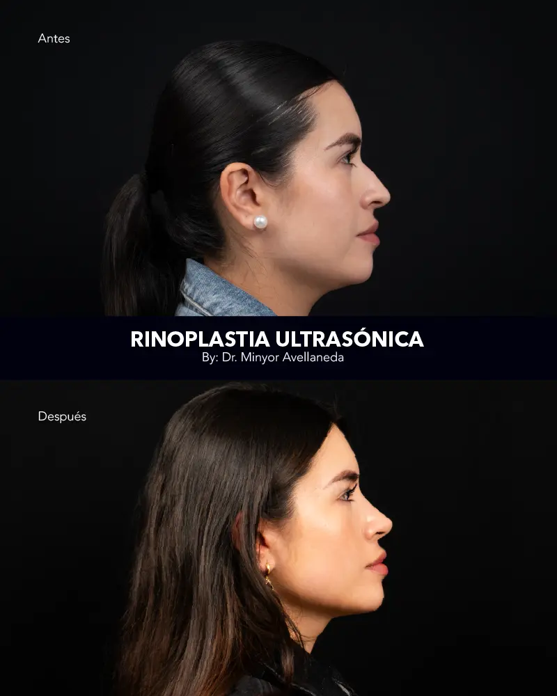 Nuevo Landing Int 5 Nuara Belleza Antes y después de operación de rinoplastia funcional y estética