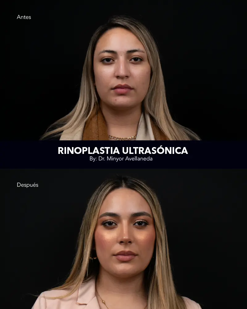 Nuevo Landing Int 4 Nuara Belleza Antes y después de rinoplastia ultrasónica: refinamiento de punta nasal