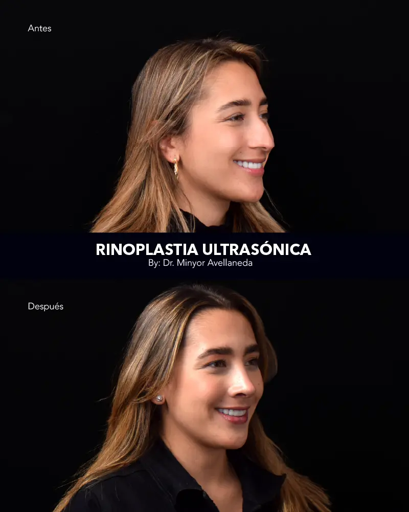 Nuevo Landing Int 3 Nuara Belleza Antes y después de rinoplastia ultrasónica: corrección de giba ósea