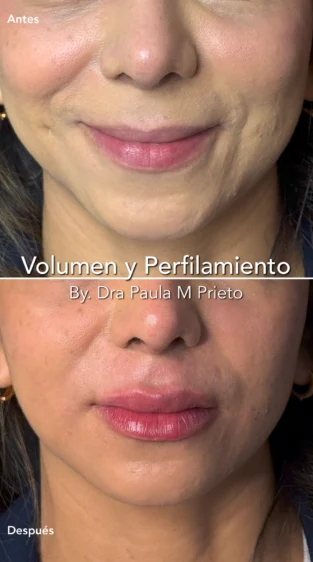 Ácido Hialurónico por Dra Paula M Prieto