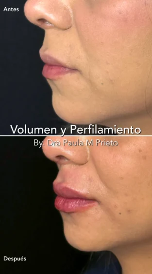 Ácido Hialurónico por Dra Paula M Prieto