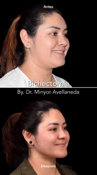 Bichectomía by Dr Minyor Avellaneda